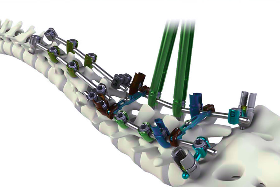 Titanium connector for biomimetic spine